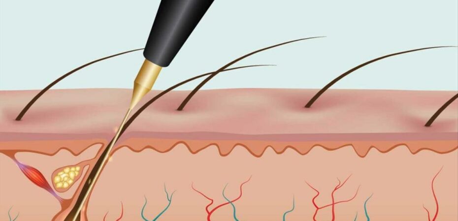 electrolysis