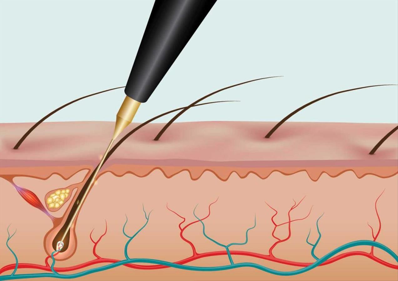 electrolysis